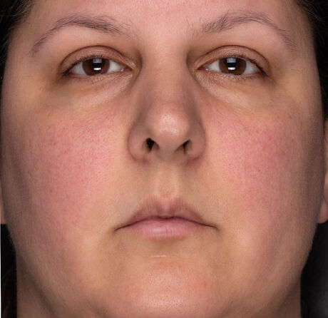 Before and After after 2 weeks of Recovery Crème Usage