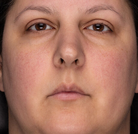 Before and After after 2 weeks of Recovery Crème Usage